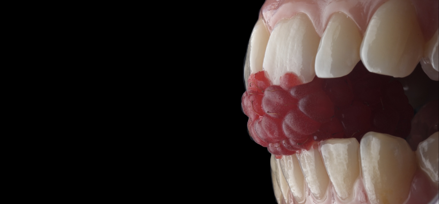 Parodontite, détartrage, chirurgie parodontale