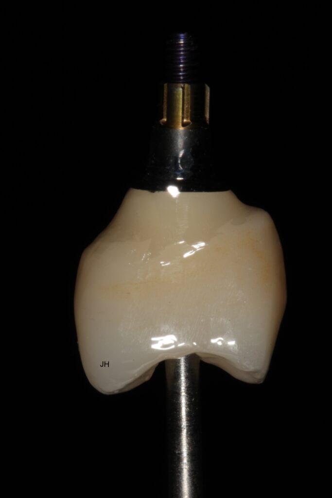 implant