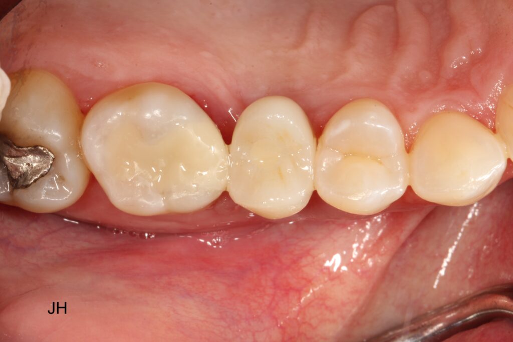 implant