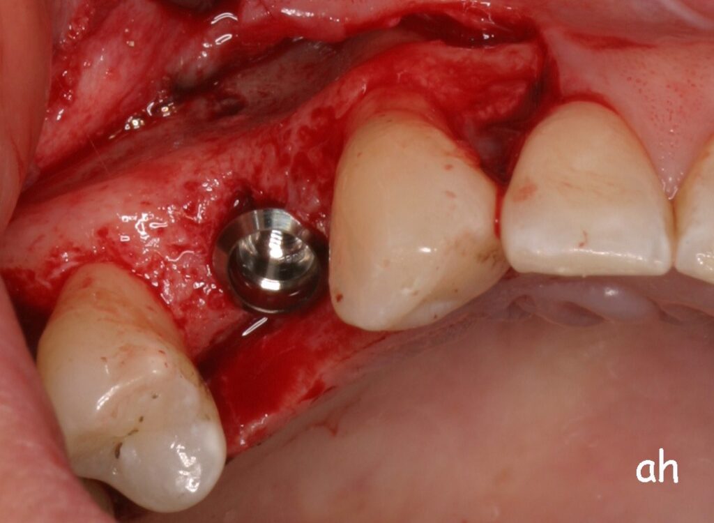 implant