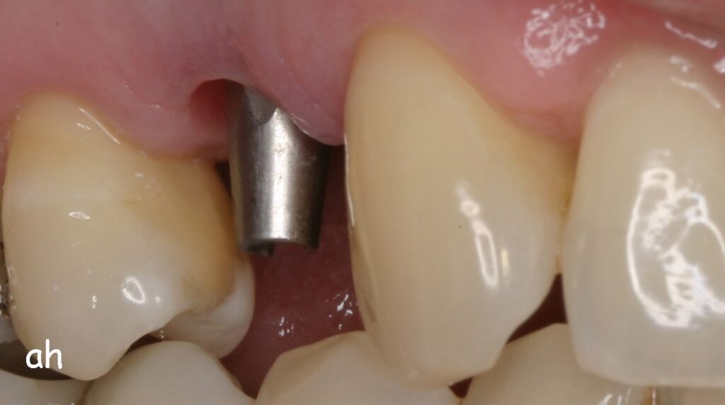 implant