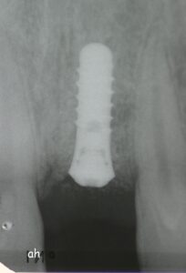 implant
