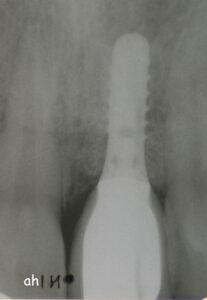implant