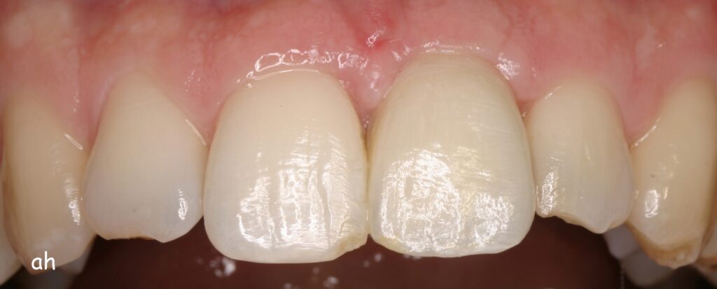 implant