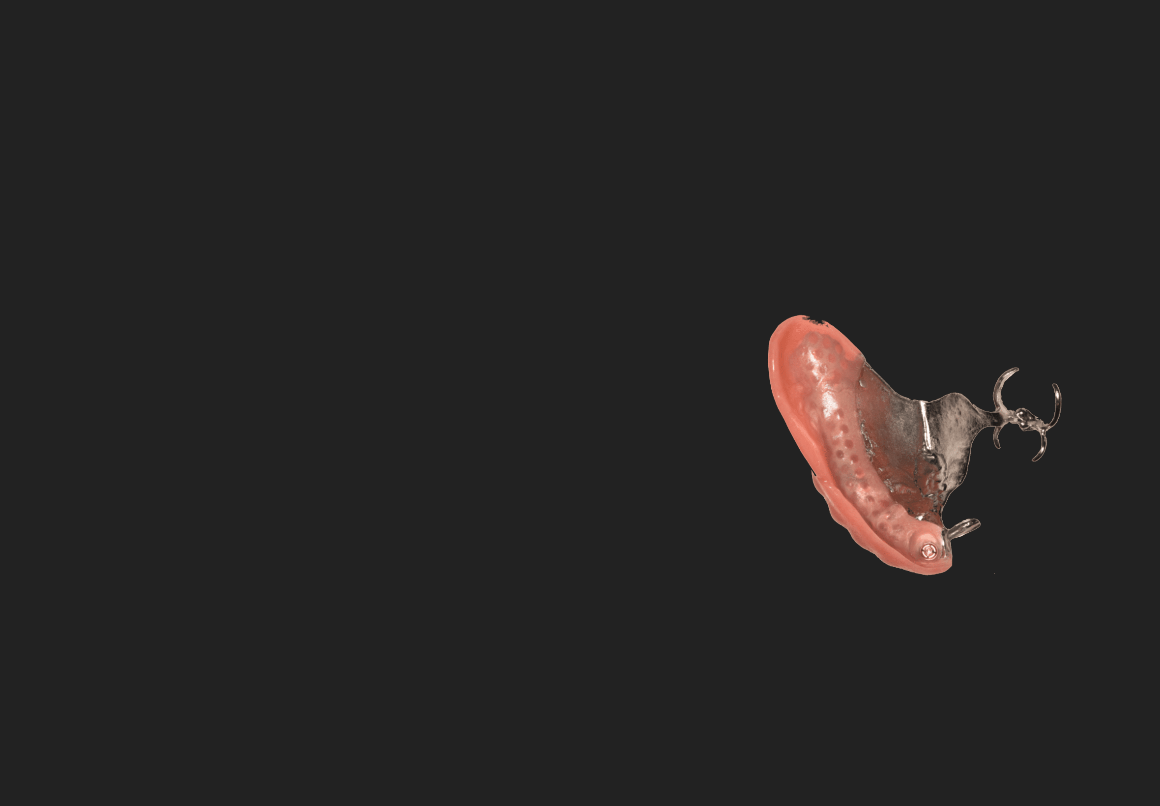 Prothèse mixte avec attachements