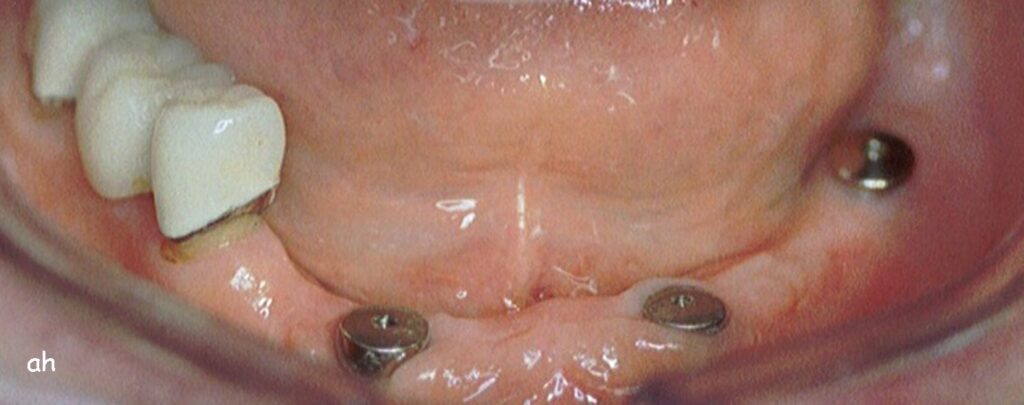 implant
